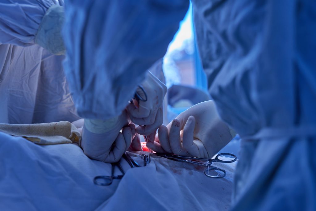 Apendicectomía por laparoscopia para endometriosis apendicular