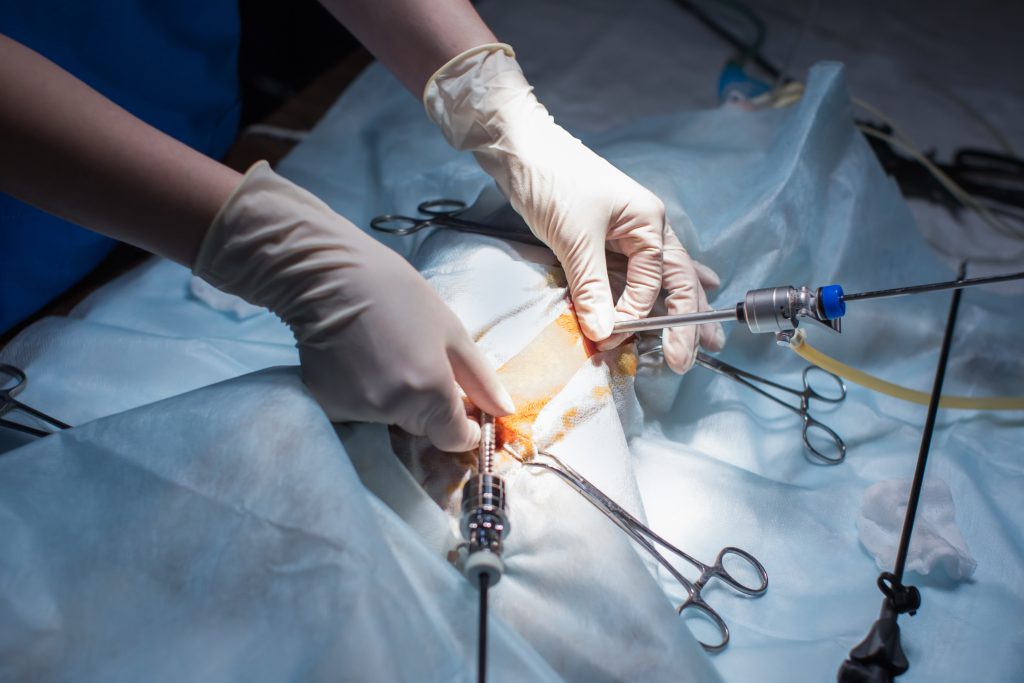 Apendicectomía por laparoscopia para endometriosis