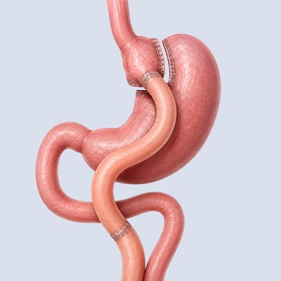 bypass-gastrico